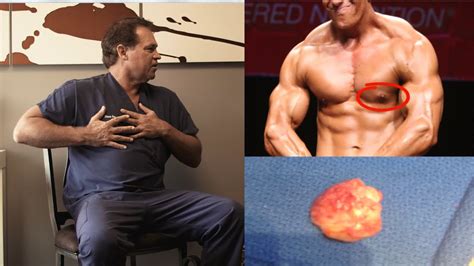 bodybuilder gyno|Gynecomastia: What Bodybuilders Need to Know .